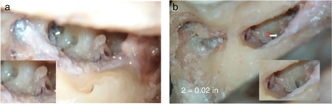 (A, B) Photographs showing saddle shaped round window membrane in
                                A and ovoid in B. In B, round window is seen to be placed more
                                inferiorly and posteriorly, an unfavorable position, but still it
                                can be seen by table adjustment.