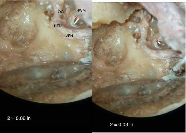 (A, B) Photographs showing measurement of maximum height and
                                width of round window membrane. (A) shows measurement of width,
                                which is in horizontal dimension and (B) shows measurement of height
                                of RWM, which is in vertical dimension. It can be seen that width is
                                more than height of RWM as it is aligned horizontally. RWM, round
                                window membrane; OW, oval window; VFN, vertical facial nerve; HFN,
                                horizontal facial nerve.