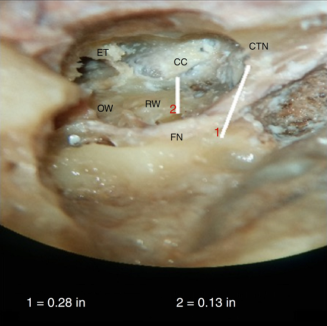 Photograph showing measurement of the minimum distance between
                                round window, RW and carotid canal, CC. FN, facial nerve; OW, oval
                                window; ET, eustachian tube opening; CTN, chorda tympani nerve. Line
                                1 is for calibration.