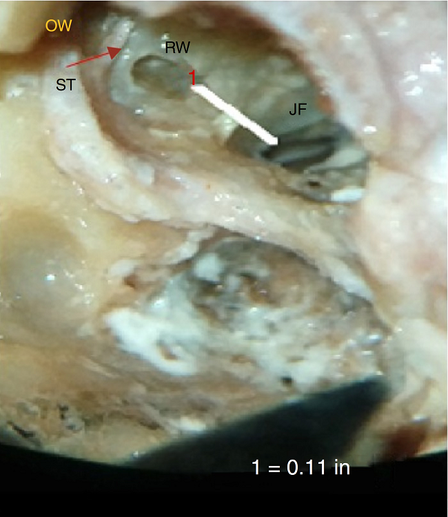 Photograph showing measurement of the minimum distance between
                                round window, RW and jugular fossa, JF. OW, oval window; ST,
                                stapedius sendon.