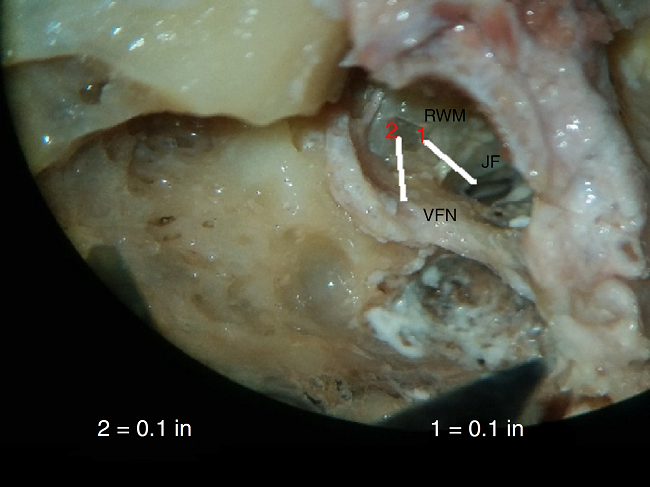 Photograph showing measurement of the minimum distance between
                                round window membrane (RWM), and vertical facial nerve (VFN). Line 1
                                is for calibration. JF, jugular fossa.