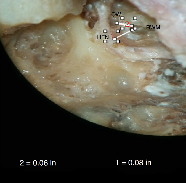 Photograph showing measurement of the minimum distance between
                                round window membrane (RWM) and horizontal facial canal (HFN), and
                                RWM and oval window (OW).