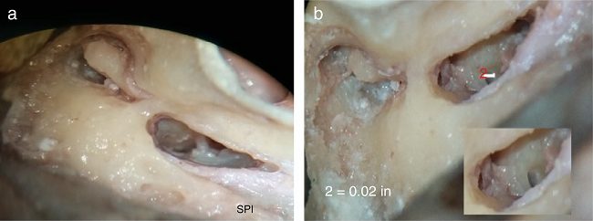 (A) Round window membrane is not visible when making posterior
                                tympanotomy, as can be seen in the photograph. (B) RW visibility
                                through facial recess after table adjustment in posteriorly placed
                                round window membrane.