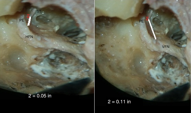 Photograph showing measurement of the minimum distance between
                                pyramidal eminence (PE) to horizontal segment (HFN) and vertical
                                segment (VFN) of facial nerve (PE-HFN and PE-VFN). ST, stapedius
                                tendon.