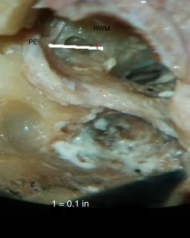 Photograph showing measurement of the minimum distance between
                                pyramidal eminence (PE) and anterior round window (PE-RW).