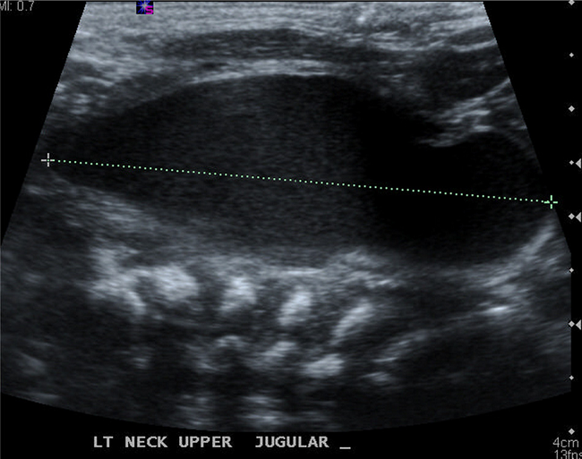 On ultrasound scan the neonatal huge neck mass (4.0 cm &times; 2.3
                            cm &times; 1.5 cm) was described as cystic mass with anechoic
                            area.