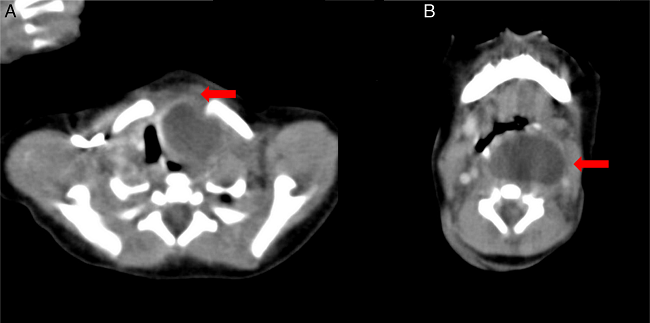Preoperative computed tomography scan shows 4.5 cm &times; 3 cm size
                            unilocular low density cystic mass which is extended into superior
                            mediastinum with compressing the trachea. A, red arrow: intrathoracic
                            lesion. B, red arrow: superior lesion.