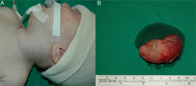 Patient photograph of the operating field. Note the diffuse swelling
                            of the left anterolateral neck (A). About 5 cm &times; 2 cm &times; 2
                            cm size soft, lobulated cystic mass which was filled with clear
                            yellowish colored fluid (B).
