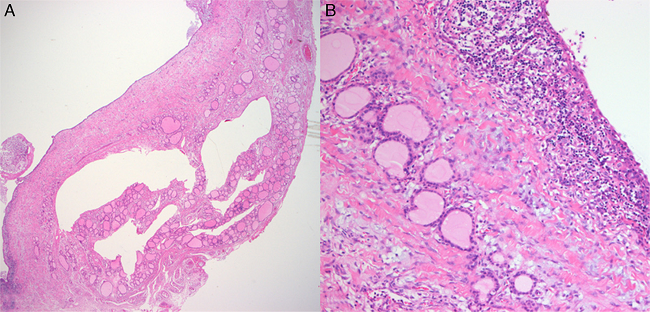 Histological finding of ultimobranchial body cyst in thyroid gland
                            (A, 100&times;). The cyst is lined by stratified squamous epithelium
                            that is slightly larger than thyroid follicular cell with surrounding
                            small lymphocytes (B, 400&times;).