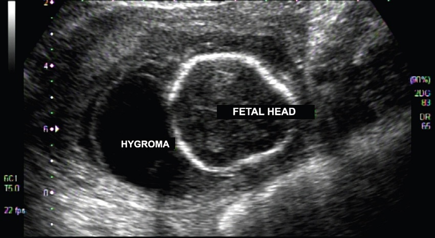 Fetal ultrasound performed at 16 weeks of gestation showing the
							cystic hygroma