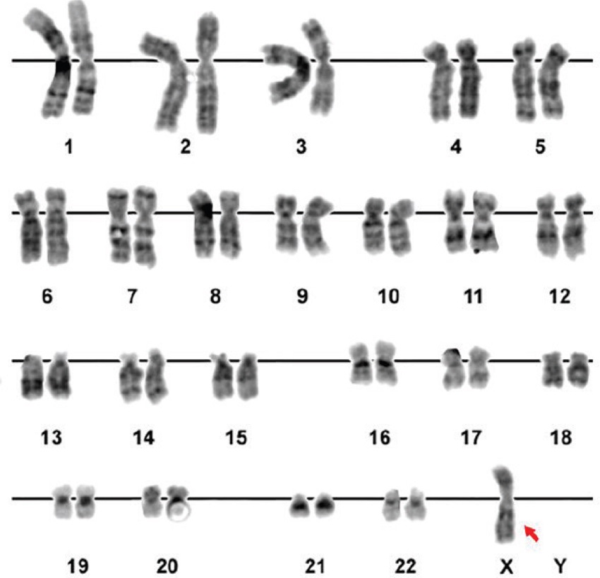 Fetal karyotyping performed from cystic hygroma cells revealing a
							X-monosomy (45,X), consistent with Turner syndrome