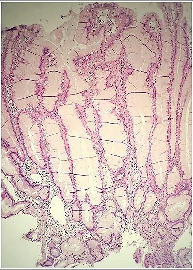 Body of the stomach affected by Ménétriér disease; hyperplasia of the
							gastric foveolar epithelium with mononuclear inflammatory infiltrates in
							the lamina propria and atrophy of oxyntic glands