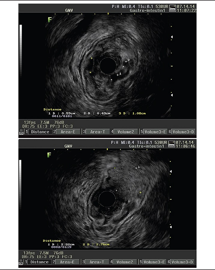 High echoendoscopy evidencing polypoid lesion in the transitional
							body-antrum gastric zone and diffuse thickening of gastric folds with
							anechoic mucous cysts