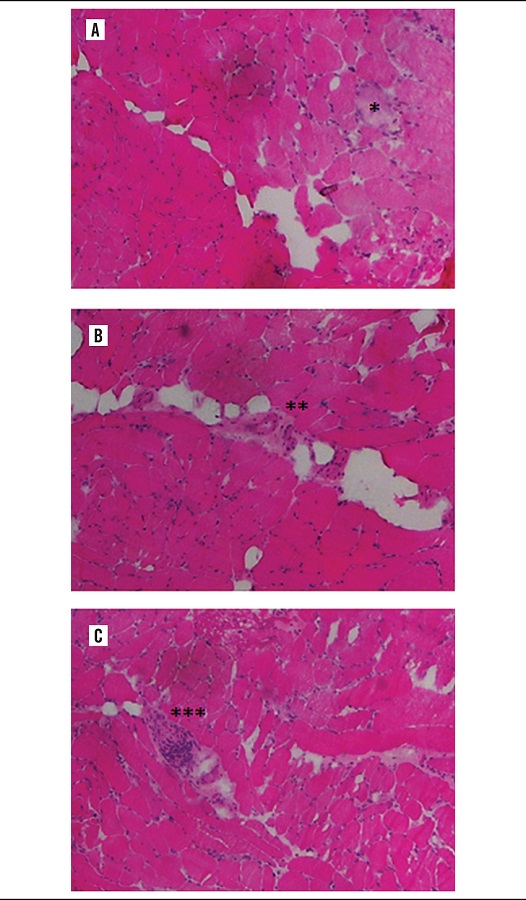 Histological section of three distinct levels of the same muscle
biopsy block from a DM patient. A) Presence of a necrotic muscle fiber
is noticed (*); B) the necrotic muscle fiber is no more observed, but
the presence of capillaries at a perimysial region (**); C) an intense
inflammatory infiltrate is perceived around these capillaries (***). HE
staining, 200× magnification