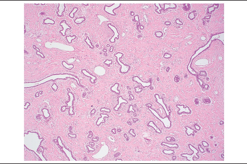 Left-breast tumor showing numerous anastomosing slit-like spaces in a
							densely collagenous stroma, involving interlobular and intralobular
							stroma (HE 40&times;)