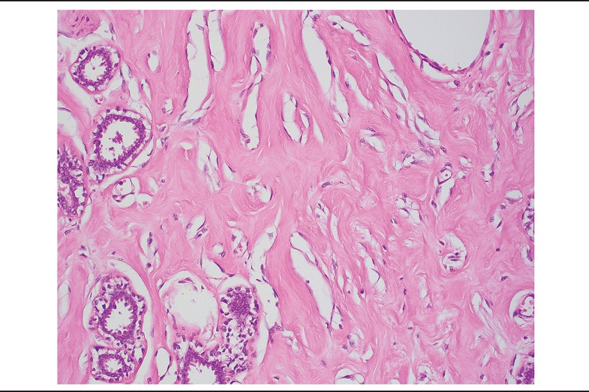 Slit-like spaces in left-breast tumor are lined by a discontinuous
							layer of bland spindle cells that lack nuclear atypia and mitosis (HE
							400&times;)