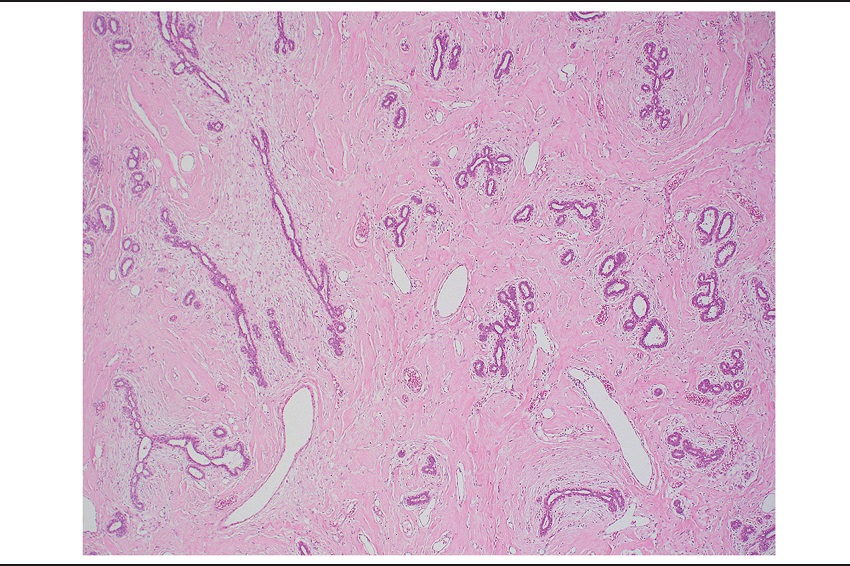 Fibroadenomatoid areas were seen in the left-breast tumor
							characterized by compressed ducts with slit-like lumens, surrounded by
							loose myxoid stroma (HE 40&times;)