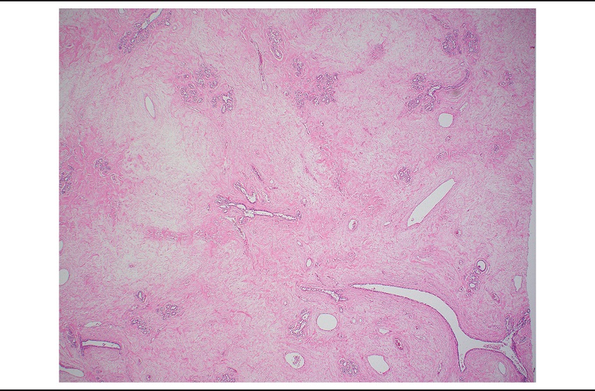 Areas of abundant edematous stroma in the left-breast tumor (HE
							40&times;)