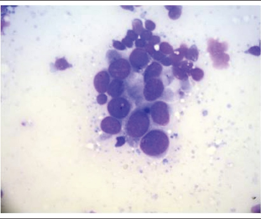 Photomicrography: sentinel lymph node cytopathology showing cohesive
							clusters of neoplastic cells with nuclear pleomorphism characterizing
							carcinoma (toluidine blue, 400&times;)