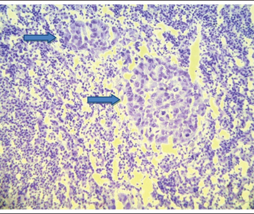 Frozen sections of lymph node with two groups of metastatic ductal
							carcinoma (arrow) amid lymphoid tissue (toluidine blue,
							100&times;)