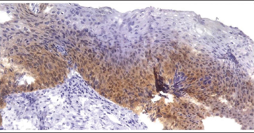 Photomicrograph of p16 immunohistochemical staining in cervical
squamous intraepithelial lesion, demonstrating minimum criteria for
positivity determination according to recommendation of LAST
Consensus: strong and diffuse block staining, continuous from the
basal layer, nuclear (or nuclear and cytoplasmic), affecting at
least the lower third of epithelium (and preferably reaching the
middle third) (100x)