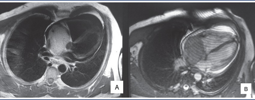 Cardiac NMR with the presence of sessile immobile heterogeneous mass,
measuring about 77 × 54 mm, situated in the interior of the right
atrium, apparently infiltrating inferior and superior venae
cavae