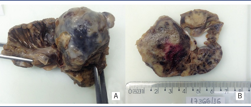 Large reddish-brown mass, occupying and infiltrating the right
atrium
