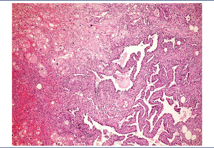 Well-differentiated area of angiosarcoma with vessels lined with
atypical endothelium permeating myocardiocytes (HE, 40x)