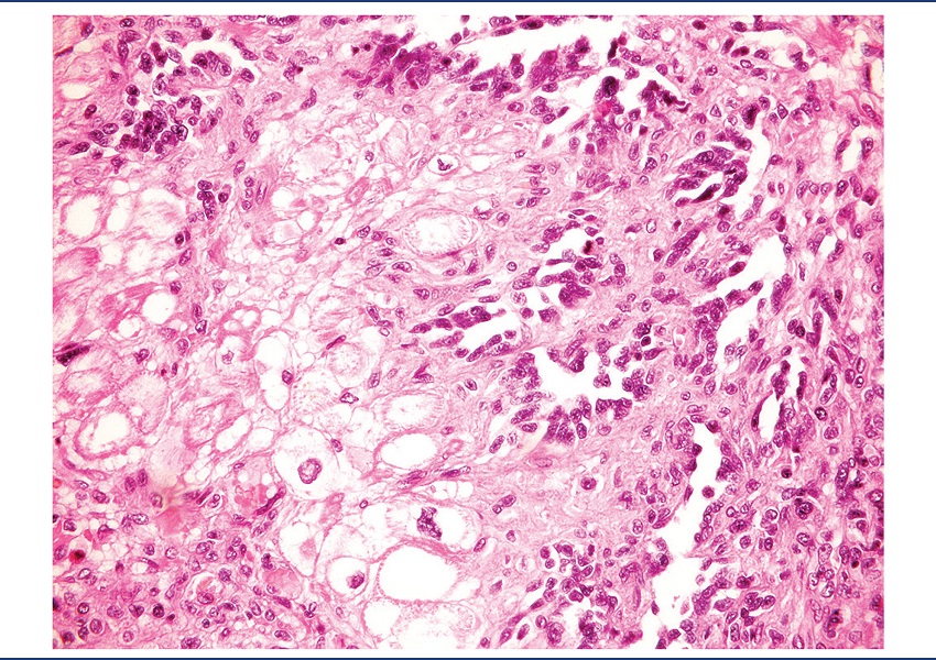 Detail of the atypical vessels permeating myocardiocytes (HE,
400x)
