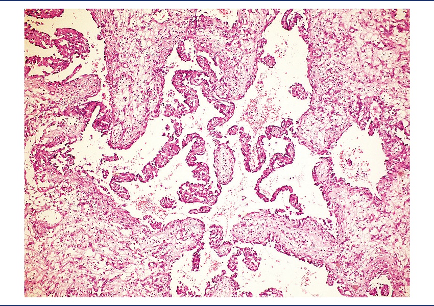 Well-differentiated area with the formation of papillae (HE,
40x)