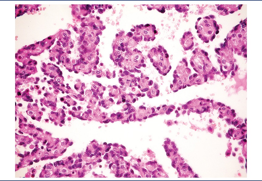 Detail of the formation of papillae lined with atypical endothelium
(HE, 400x)