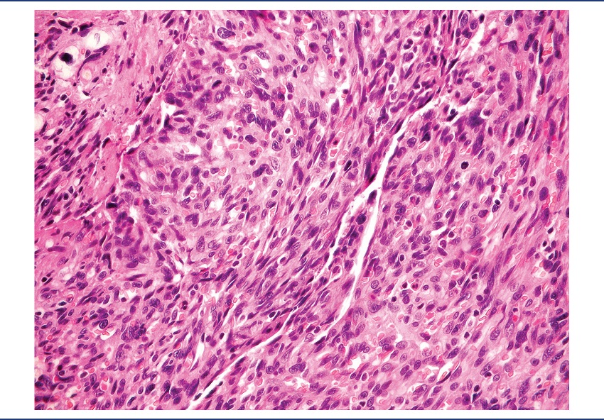 Poorly differentiated solid area of the angiosarcoma (HE,
400x)
