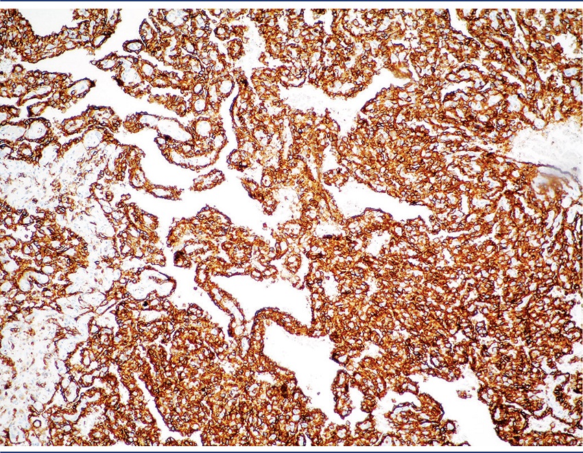 Immunohistochemistry positive for CD31 (100x)