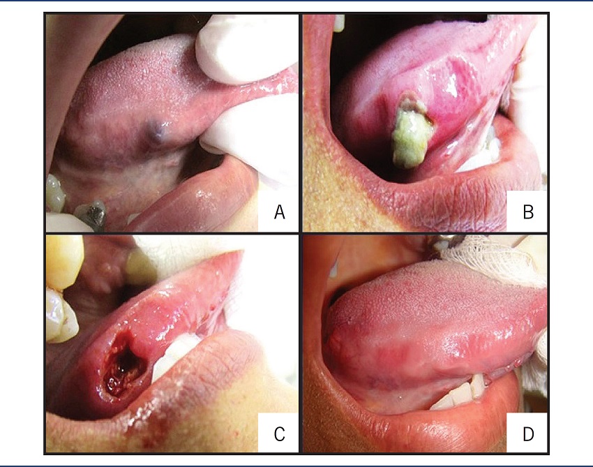 Clinical features of the intraoral aspect of the lesion