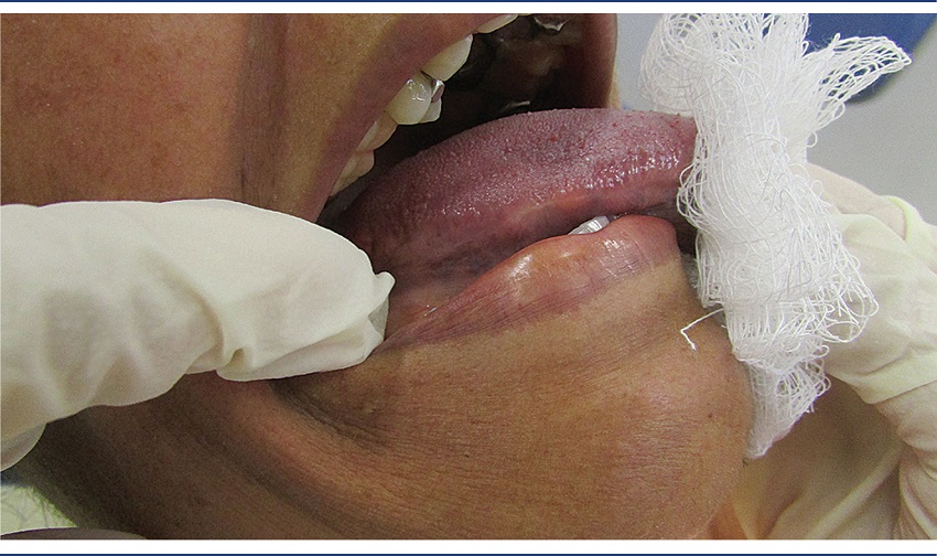 Clinical follow-up of the patient after two years of treatment:
							aspect of the lateral border of tongue, intact, without presence of
							lesion relapse