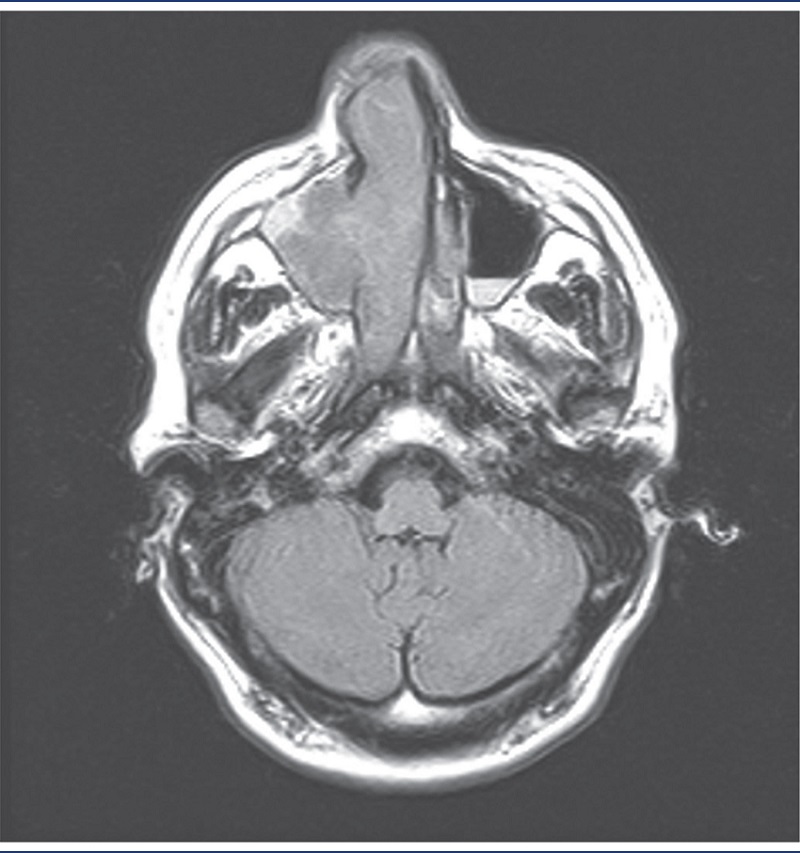 MRI of axial section in FLAIR sequence, in which an expansive mass is
visible, occupying the nasal cavity and the maxillary sinus on the
right, with enlargement of drainage ostium