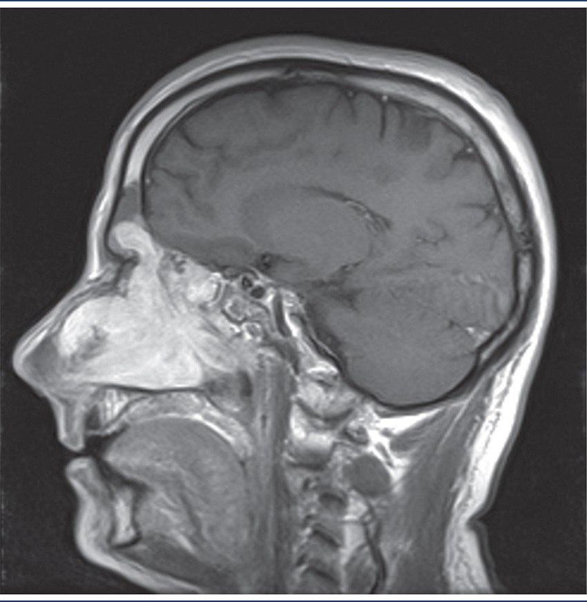 MRI of sagittal section in T1 sequence after administration of
gadolinium contrast, in which one observes, on the right side, lesion
extension to ethmoid cells and frontal sinus
