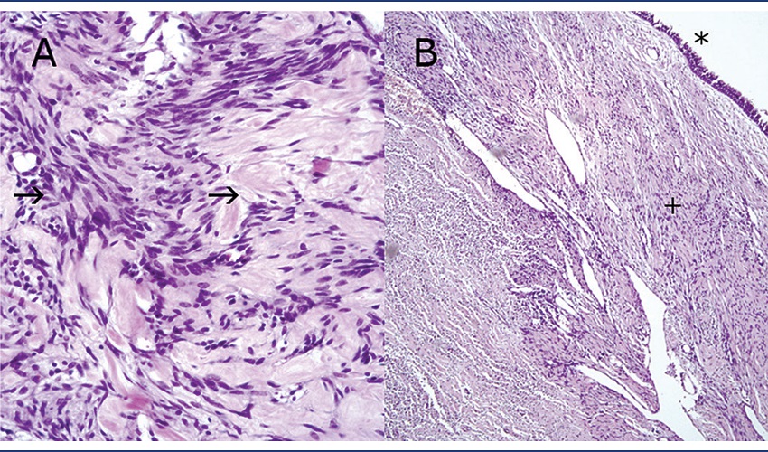 Photomicrographs presenting tumoral cellularity in A, syncytial cells
with round or elongated nuclei, with hyalinization foci (arrows) (HE
stain, magnification 200x); in B, respiratory-type mucosa (*) with
dilation of vessels, submucosal edema and increased cellularity of
stroma (+) (HE staining, magnification 50x)