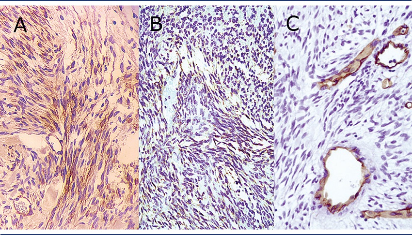 Photomicrographs showing neoplastic cells positive for actin
antibodies (A), vimentin (B), and negative for CD31 (C).
Immunohistochemical reaction – DAB stain – magnification 400x in A and
C, and 200x in B