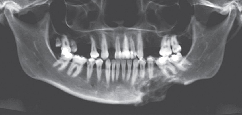 Postoperative imaging Follow-up with panoramic radiograph, evidencing
							radiopacity, decrease of lesion extension and presence of bone callus in
							the region