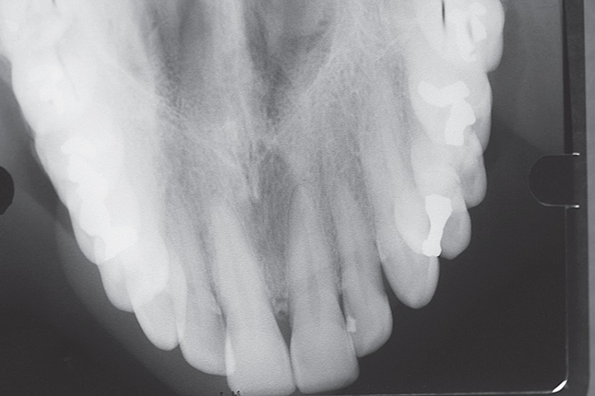 Maxillary occlusal radiography showing unilocular radiolucent image
							related to the upper central incisors
