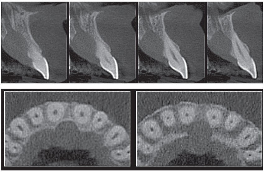 Parasagittal and axial of CT sections showing well-defined hypodense
							area in continuity with the incisive canal, measuring 15 × 13
							mm