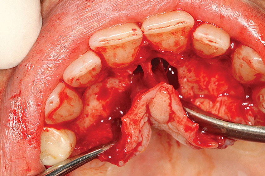 Intrasulcular incision and detachment of the palatal mucosa