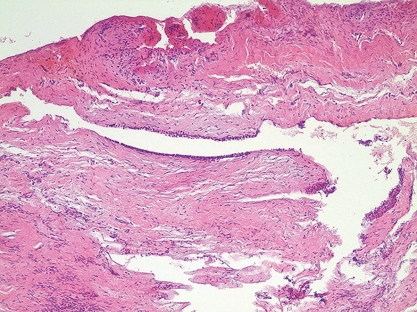 Photomicrography of case 1 showing cystic cavity covered by
							epithelium (HE, 100×)