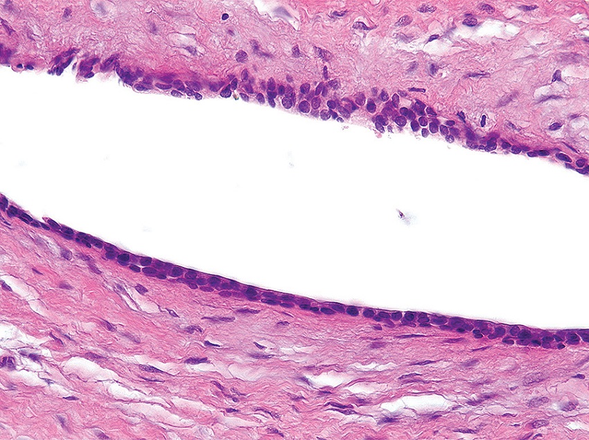 Cystic cuboidal epithelial lining with few layers and fibrous
							connective tissue capsule (HE, 400×)