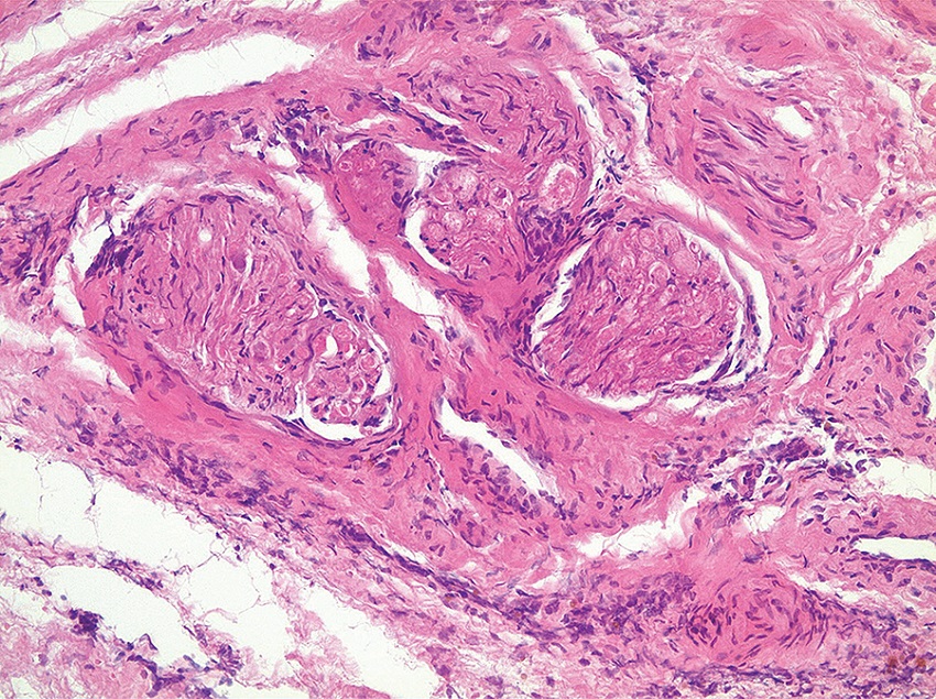 Nerve bundle present in the cystic capsule (HE, 200×)