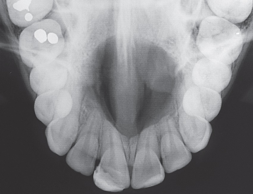 Maxillary occlusal radiography showing well-defined unilocular
							radiolucent image in maxillary anterior region