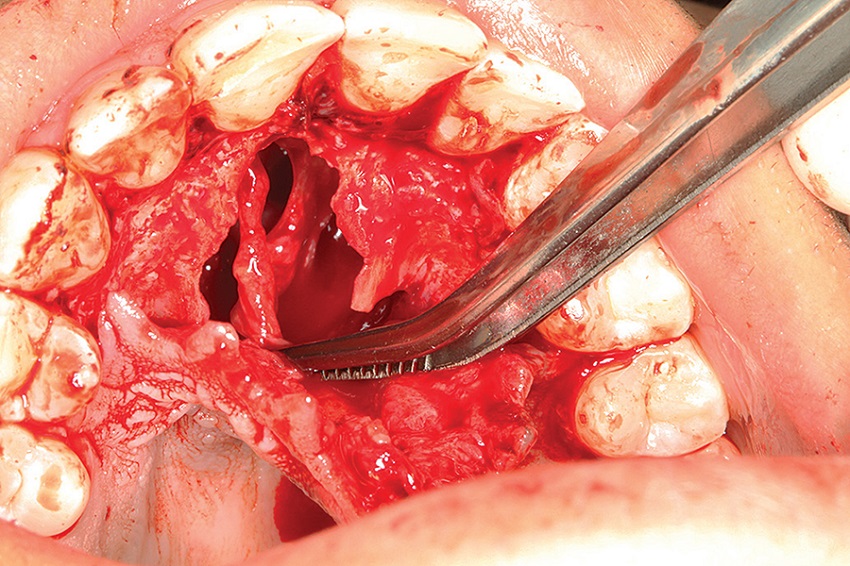 Enucleation of the cyst