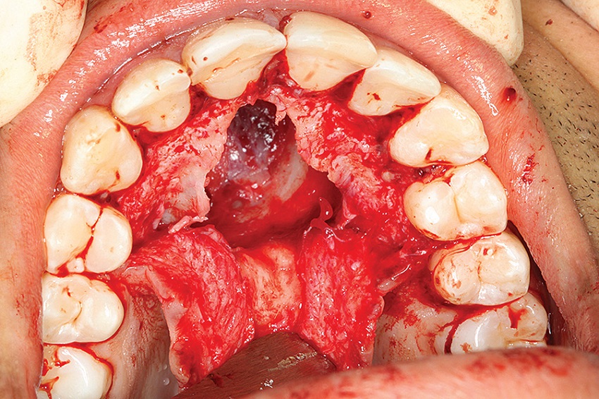 Surgical cavity