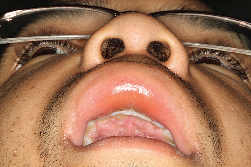 Swollen lip of patient of case 2 due to postoperative
							infection
